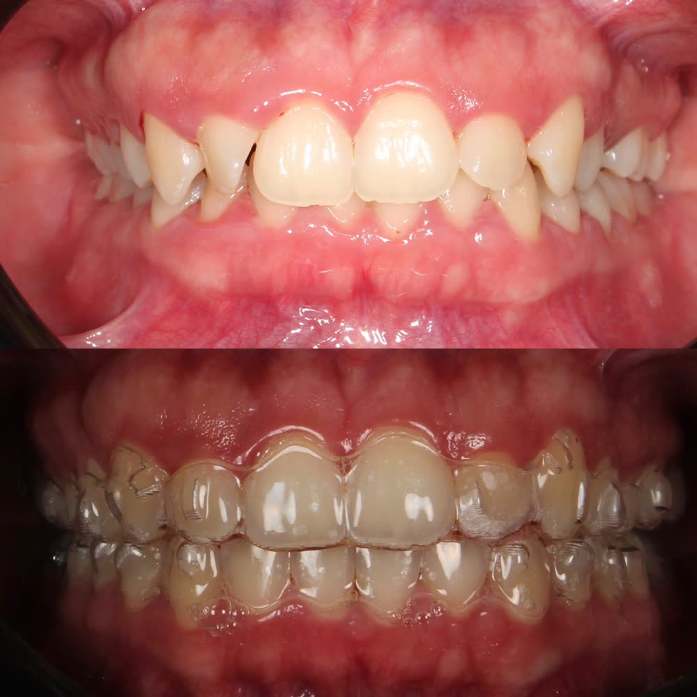 Antes y después de un caso de ortodoncia invisible hecho en Smile Align