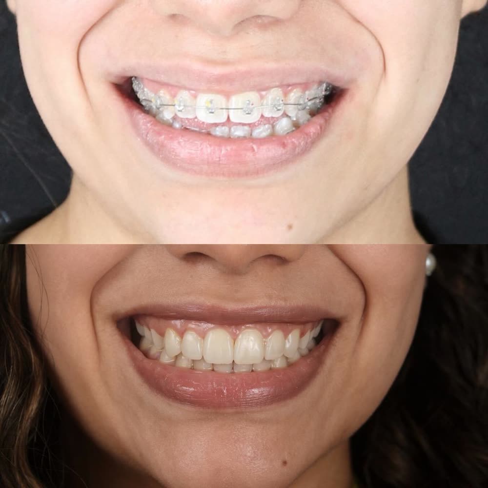 Antes y después de un caso de ortodoncia con brackets hecho en Smile Align