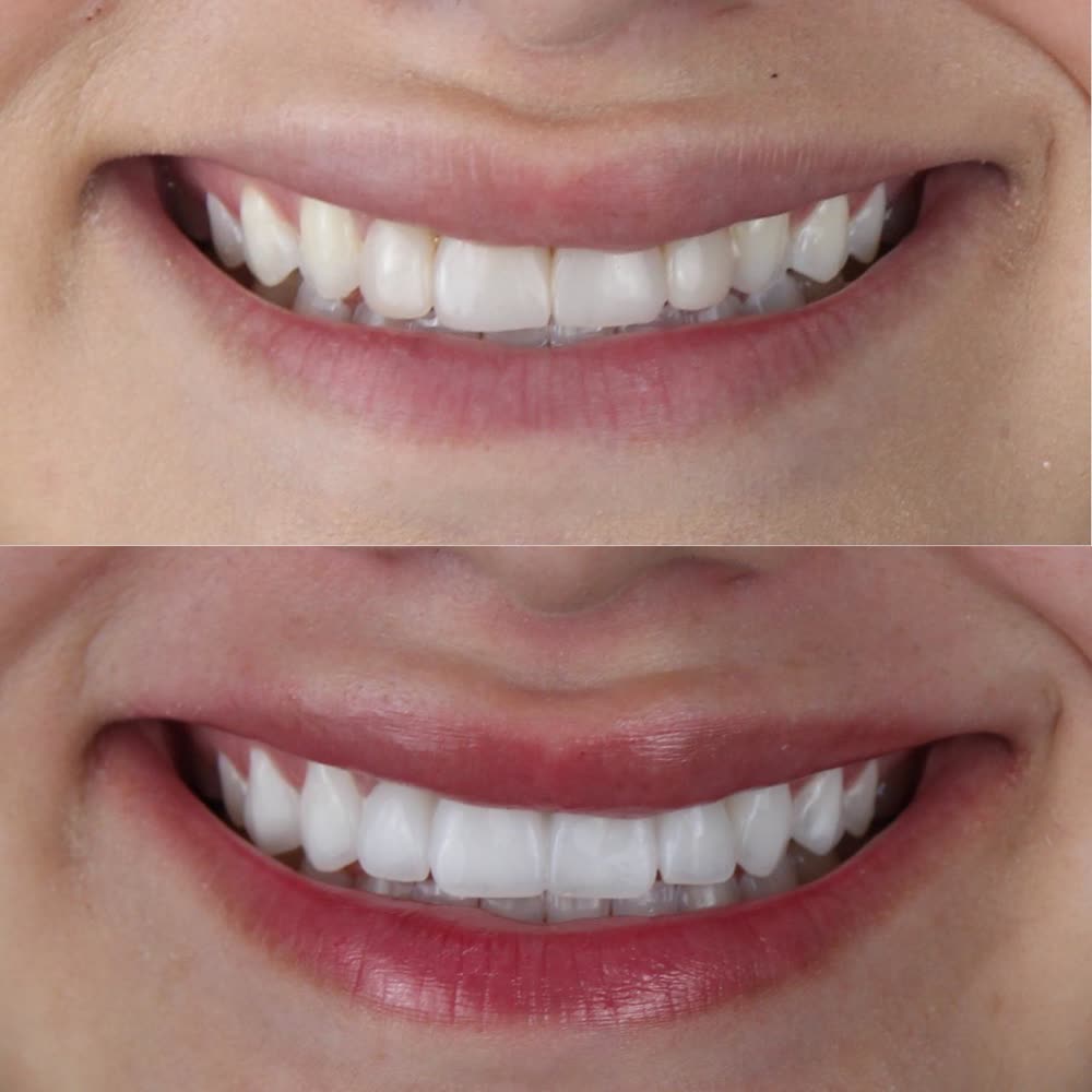 Antes y después de un caso de carillas de porcelana hecho en Smile Align