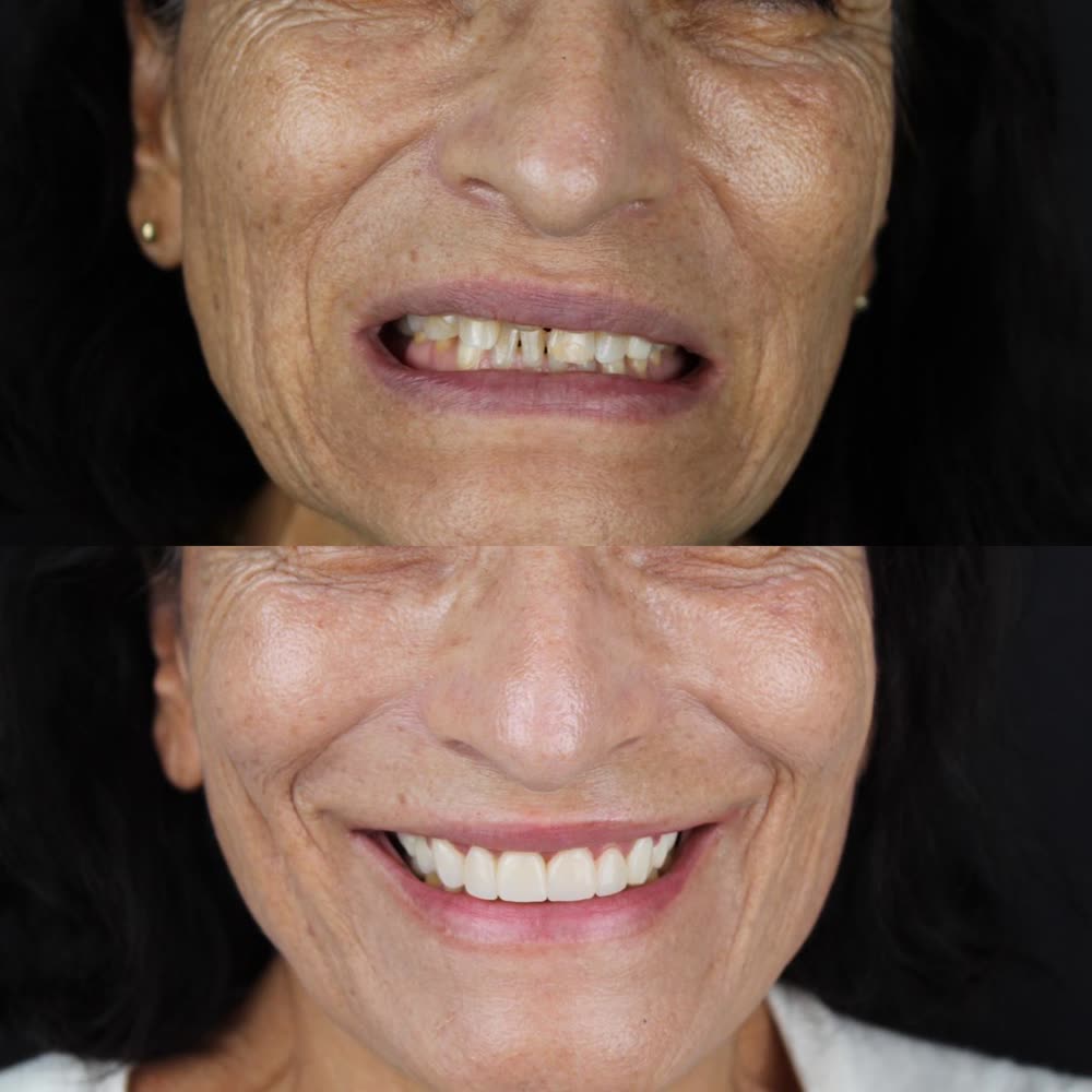 Antes y después de un caso de rehabilitación hecho en Smile Align