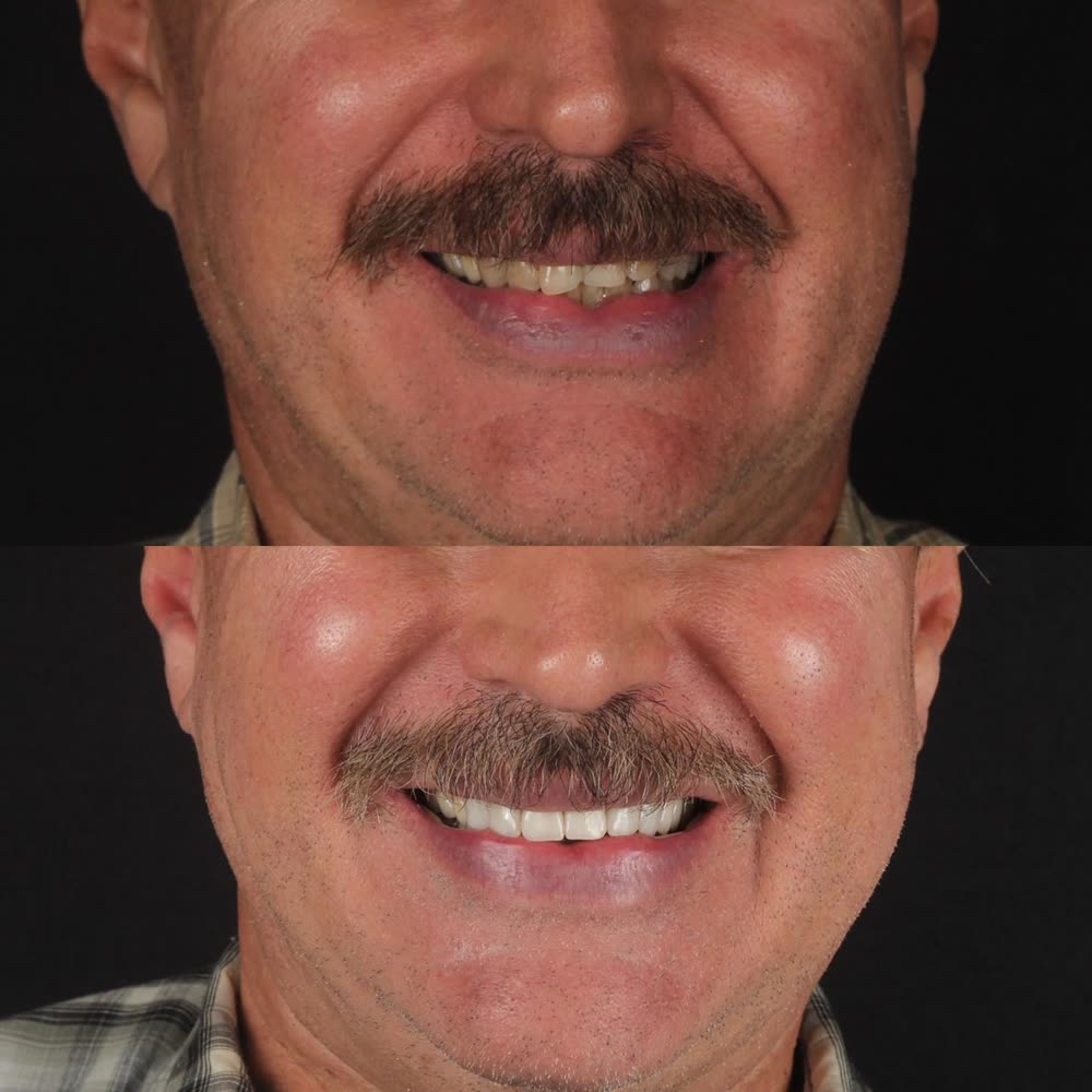 Antes y después de un caso de rehabilitación hecho en Smile Align