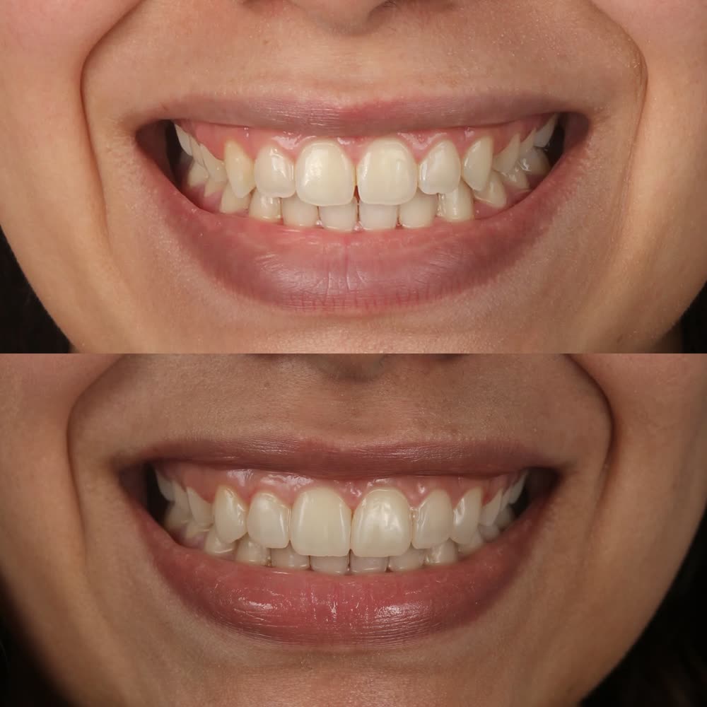 Antes y después de un caso de carillas de resina hecho en Smile Align