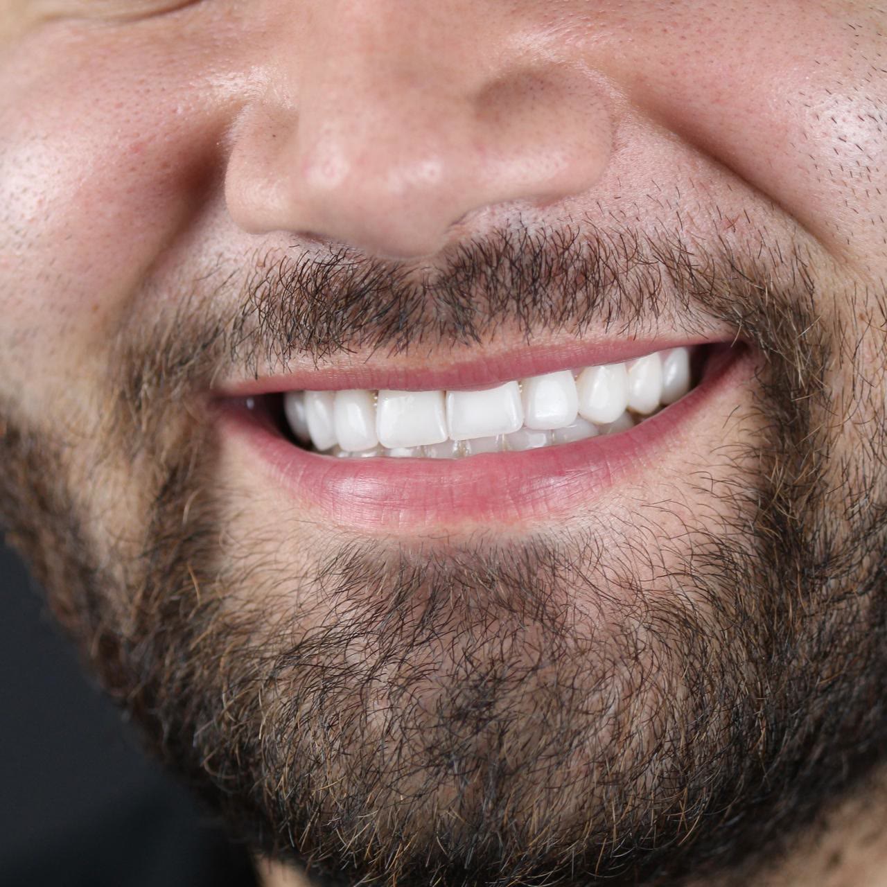 Sonrisa con carillas de porcelana hechas en Smile Align